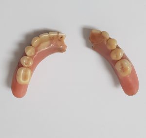 Prótesis dental inferior completa fracturada