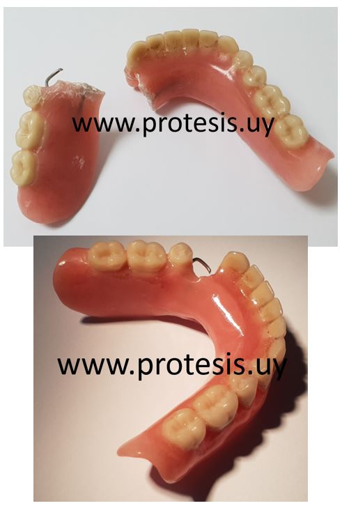 protesis dental parcial removible fracturada