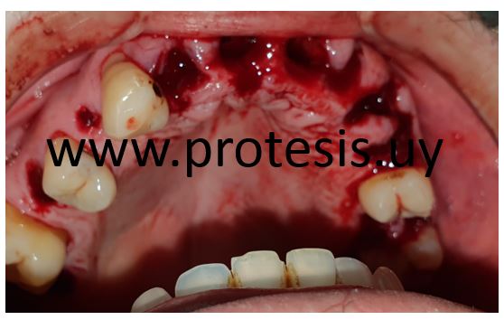 protesis dental parcial que se coloca inmediatamente a la extraccion de las piezas dentales evita que el paciente esté sin dientes