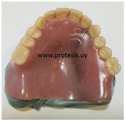 rotura fisura del paladar de la protesis dental completa