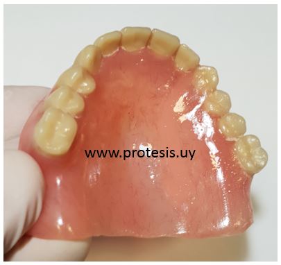 reparación de prótesis dental de urgencia realizada